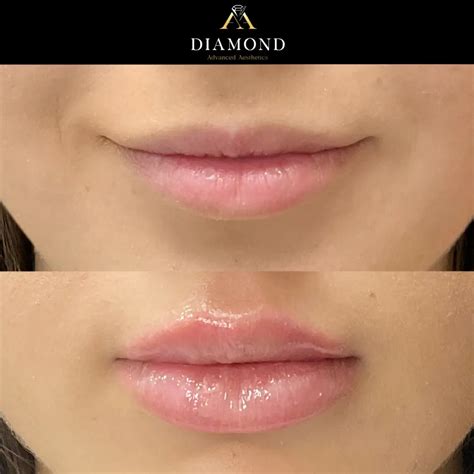 lip flip nyc|Lip Fillers in New York, NY 